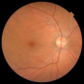 How does diabetes affect the Retina?