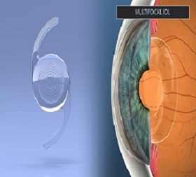 Clear Lens Extraction